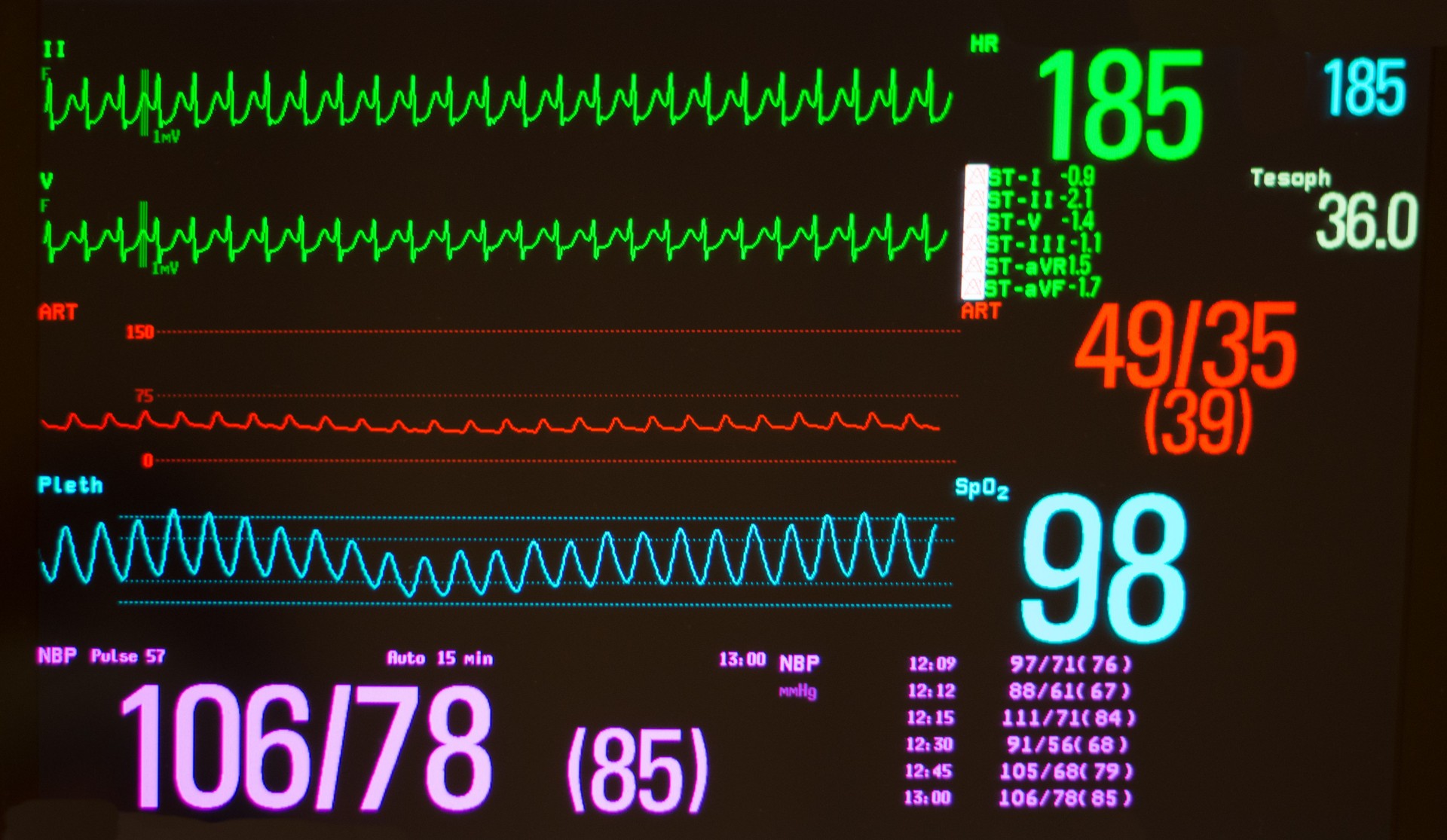 Atrioventricular Node Re-Entrant Tachycardia, Arterial Blood Pressure, Pulse Oximeter Waveform and Vital Signs on a Medical Monitor